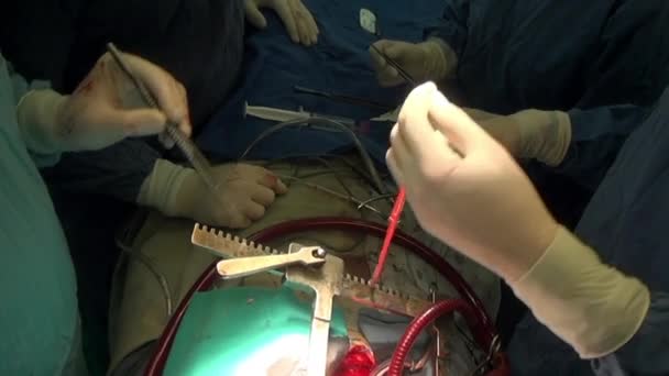 Kalp ameliyatı benzersiz makro video yakın çekim Kliniği. — Stok video