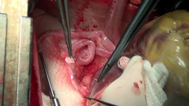 Hastanın kliniği işlemi sırasında canlı organ üzerinde cerrahi iplik ile kalp. — Stok video