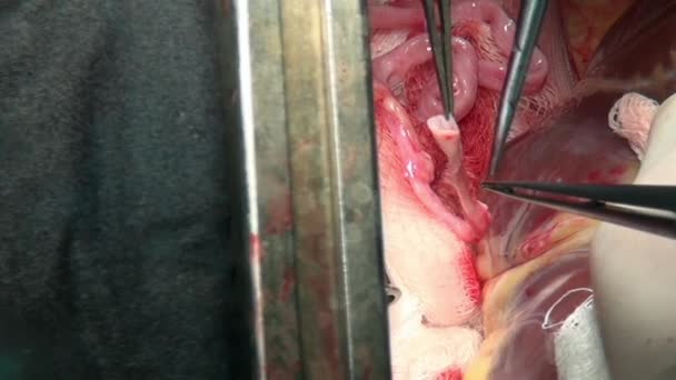 Heart with surgical thread on live organ of patient during operation in clinic. — Stock Video