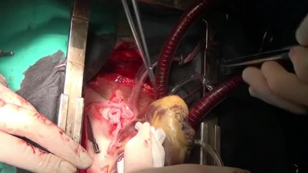 Srdeční chirurgie jedinečné makro video zblízka v klinice. — Stock video