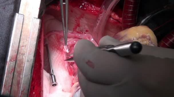 Cirurgia cardíaca único macro vídeo close-up na clínica . — Vídeo de Stock