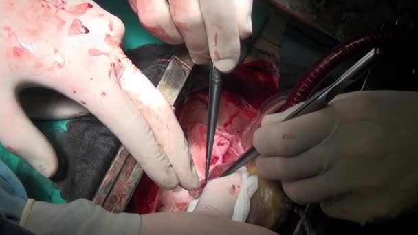 Surgeon sews up heart during operation on live organ of person in clinic. — Stock Video