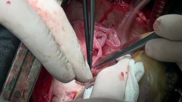 Surgeon sews up heart during operation on live organ of person in clinic. — Stock Video