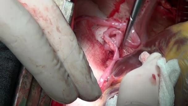 Chirurg naait hart tijdens bewerking uitgevoerd op live orgel van persoon in kliniek. — Stockvideo
