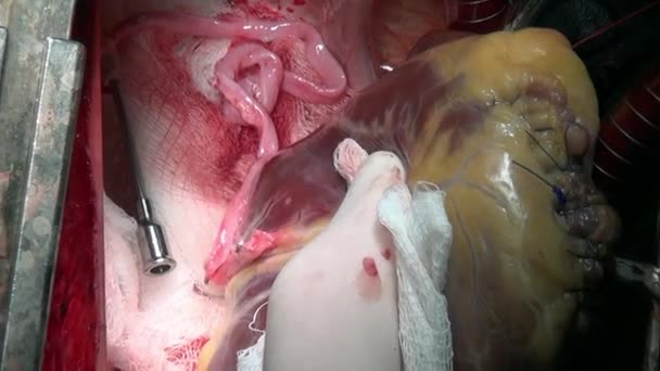 Cortar el plano del corazón por cirujano médico profesional único macro video en la clínica . — Vídeo de stock