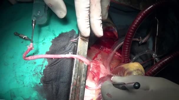 Kalp klinik bizzat canlı organ üzerinde çalışması sırasında. — Stok video
