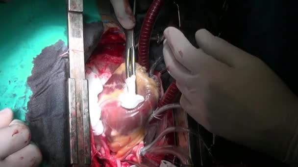 Heart during operation on live organ of person in clinic. — Stock Video