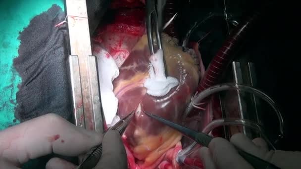 ตัดการผ่าตัดหัวใจในอวัยวะสด วิดีโอแมโครที่ไม่ซ้ํากันในคลินิก . — วีดีโอสต็อก