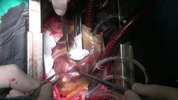 Hartoperatie op levende orgel unieke macro video knippen in kliniek. — Stockvideo