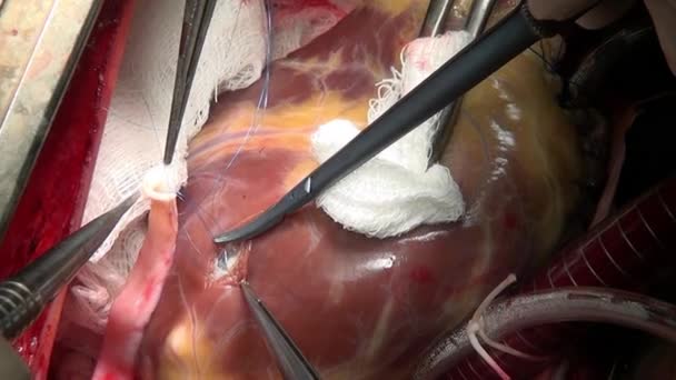 Heart surgery in clinic. — Stock Video