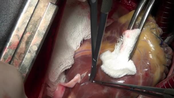Operacji serca w klinice. — Wideo stockowe
