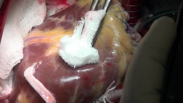 ศัลยแพทย์เย็บหัวใจระหว่างการผ่าตัดเกี่ยวกับอวัยวะที่มีชีวิตของบุคคลในคลินิก . — วีดีโอสต็อก