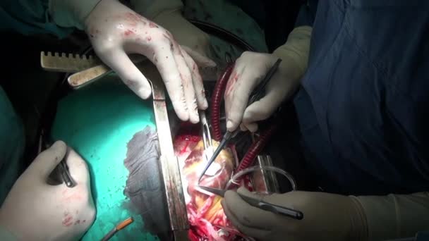 Хирург зашивает сердце во время операции на живом органе человека в клинике . — стоковое видео