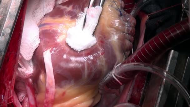 외과 의사 클리닉에 사람의 라이브 기관에 작업 중 심장을 sews. — 비디오