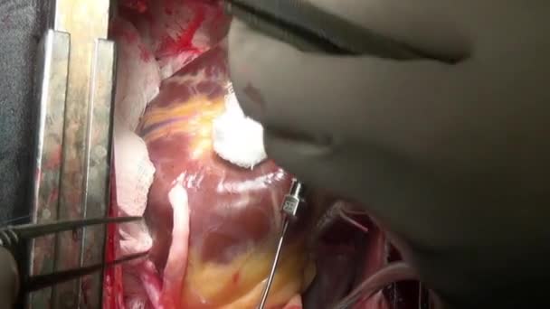 Cerrahın kliniğinde kişinin canlı organ işlemi sırasında kalbini diker. — Stok video