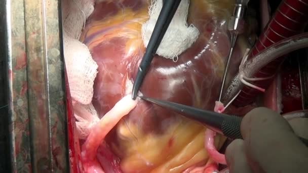 Chirurg naait hart tijdens bewerking uitgevoerd op live orgel van persoon in kliniek. — Stockvideo
