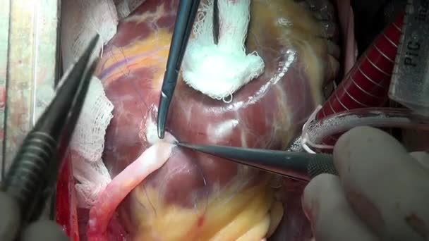 Kirurg syr hjertet under operation på levende organ af person i klinikken . – Stock-video
