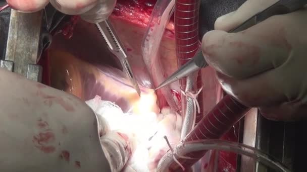 Srdce rovinu řezu odborný lékař chirurg, jedinečné makro video v klinice. — Stock video