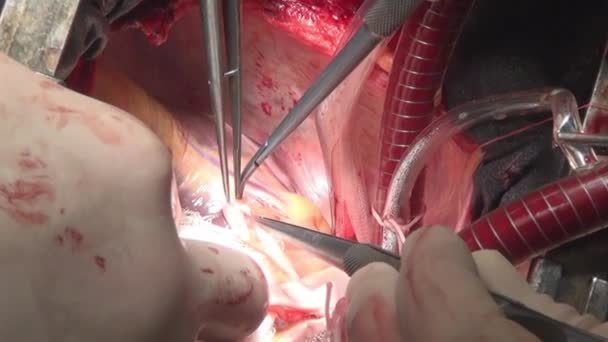 Il chirurgo cuce il cuore durante operazione su organo vivo di persona in clinica . — Video Stock