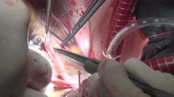 Surgeon sews up heart during operation on live organ of person in clinic. — Stock Video