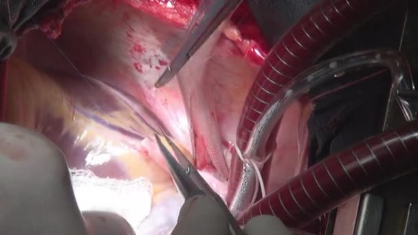 ศัลยแพทย์เย็บหัวใจระหว่างการผ่าตัดเกี่ยวกับอวัยวะที่มีชีวิตของบุคคลในคลินิก . — วีดีโอสต็อก