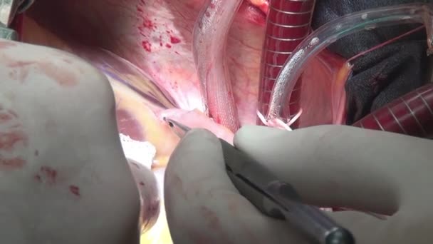 Cirujanos manos hacen cirugía cardíaca en la clínica . — Vídeos de Stock