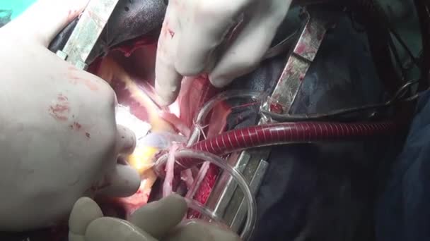 Cirujanos manos hacen cirugía cardíaca en la clínica . — Vídeo de stock