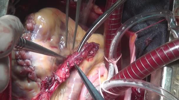 Cirujanos manos hacen cirugía cardíaca en la clínica . — Vídeos de Stock