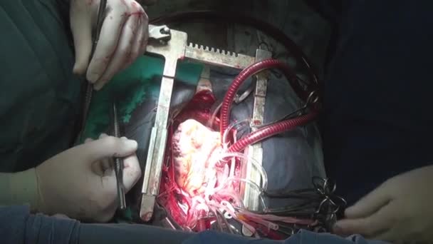 Heart surgery on live organ of person in clinic. — Stock Video