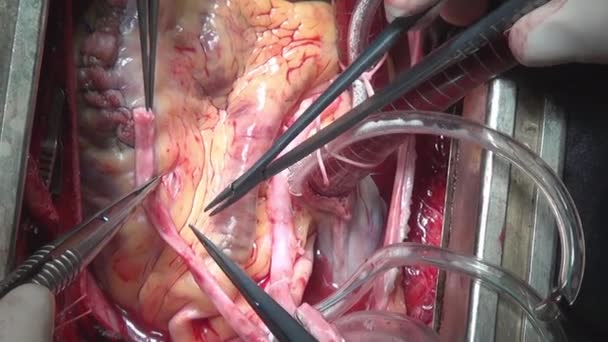 Heart surgery on live organ of person in clinic. — Stock Video