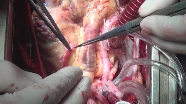 Heart surgery on live organ of person in clinic. — Stock Video