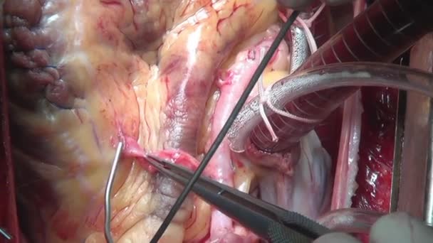 Heart during operation on live organ of person in clinic. — Stock Video