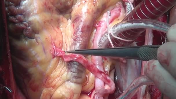 Heart during operation on live organ of person in clinic. — Stock Video