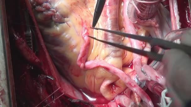 Heart surgery on live organ of person in clinic. — Stock Video