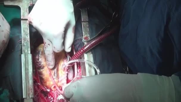 Heart during operation on live organ of person in clinic. — Stock Video