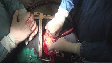 Canlı organ benzersiz makro video kalp cerrahi operasyon klinikte kapat.