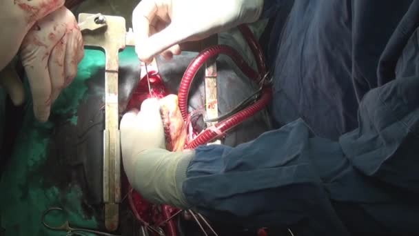 Coração durante a operação no órgão vivo da pessoa na clínica . — Vídeo de Stock
