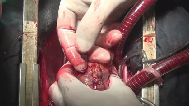 Сердце во время операции на живом органе человека в клинике . — стоковое видео