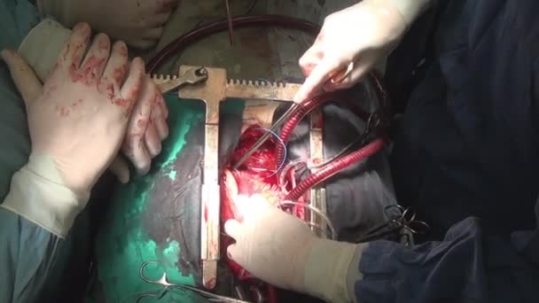 Heart during operation on live organ of person in clinic. — Stock Video