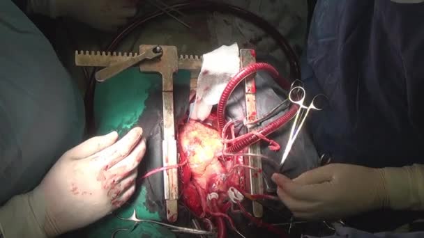 Сердце бьется во время операции на живой орган уникальное макровидео крупным планом в клинике . — стоковое видео