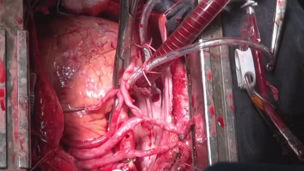หัวใจเต้นระหว่างการผ่าตัดในอวัยวะสด วิดีโอแมโครที่ไม่ซ้ํากันใกล้เคียงในคลินิก . — วีดีโอสต็อก