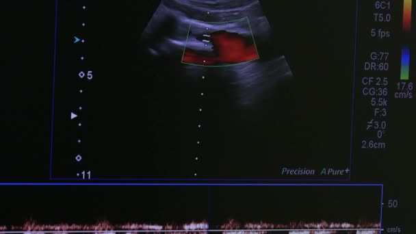 Immagine di donna utero sul monitor ultrasuoni attrezzature esame . — Video Stock