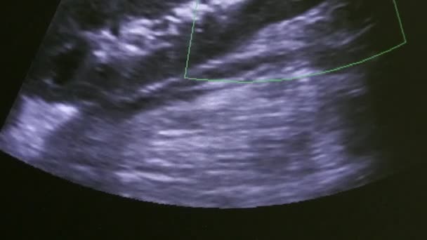 Imagen del útero de la mujer en el equipo de examen de ultrasonido monitor . — Vídeo de stock