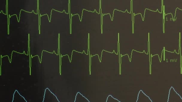 Cardiogram of rhythm of heart and pulse image on monitor during operation. — Stock Video