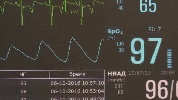 Cardiogram of rhythm of heart and pulse image on monitor during operation. — Stock Video