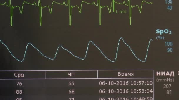 Kardiogramm des Herzrhythmus und des Pulses während der Operation auf dem Monitor. — Stockvideo