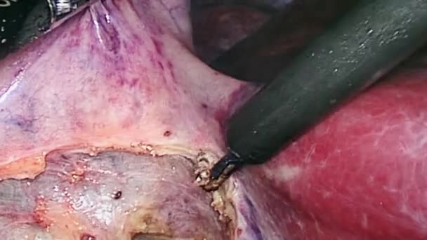 Внутри брюшной полости во время операции лапароскопия . — стоковое видео