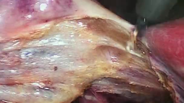 Karın boşluğu içinde işlem laparoskopi sırasında. — Stok video