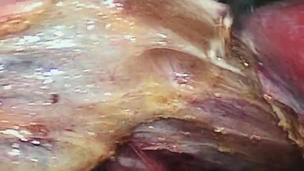 Abdominal cavity inside during operation laparoscopy. — Stock Video