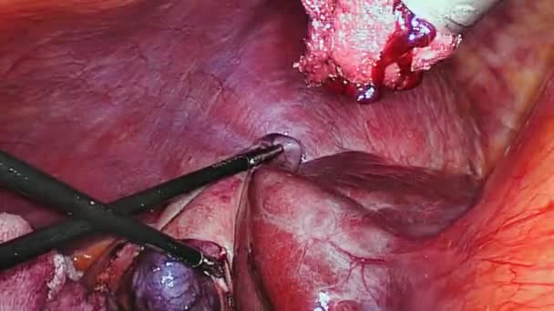 操作腹腔鏡検査で腹腔内. — ストック動画